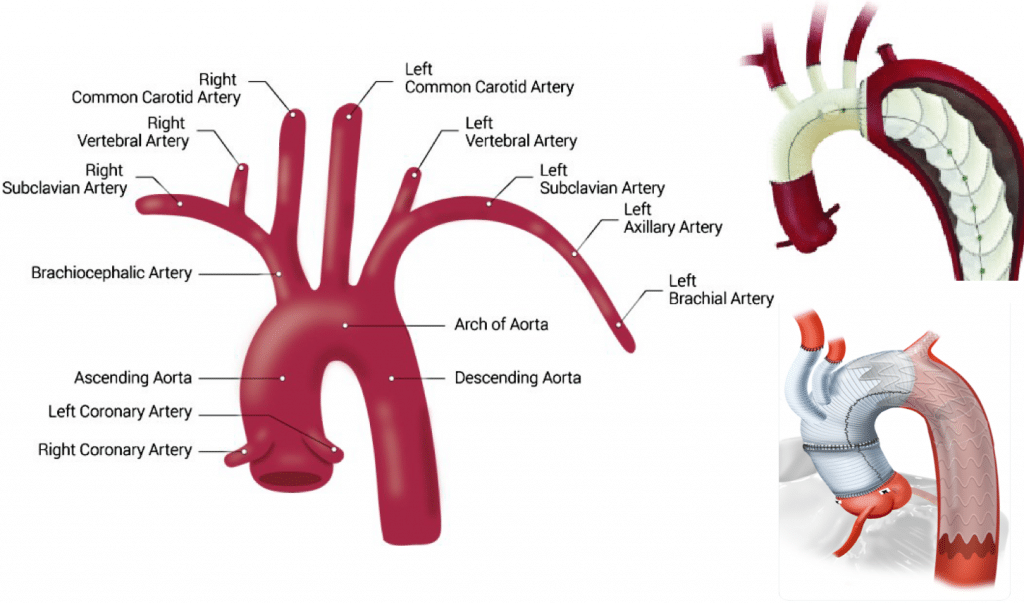 Aorta surgery - פרופסור ירון ברק